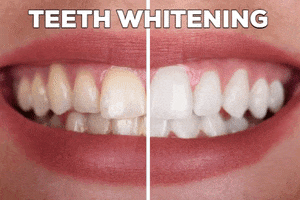 Teeth Whitening GIF