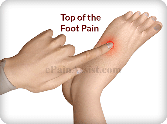 plantar fasciitis top of foot