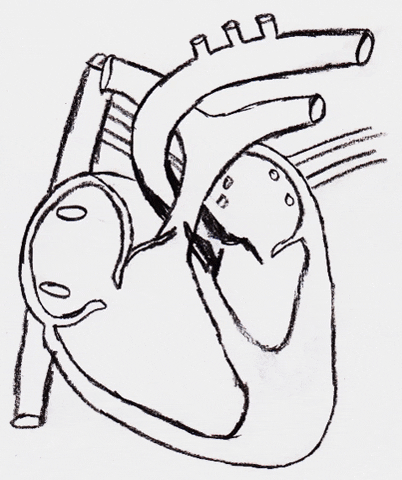 Aortic Stenosis Congenital Heart Defect GIF