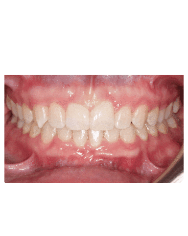 Teeth Braces Sticker by Hometown Orthodontics