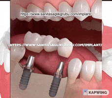 Httpswwwsanitasaglikgrubucomimplant GIF