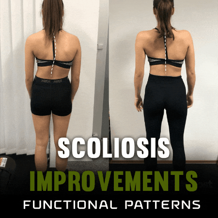Scoliosis GIF by functionalpatterns