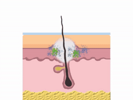 Ophelia Cures Acne GIF