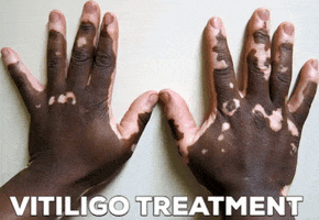 Vitiligo Treatment GIF