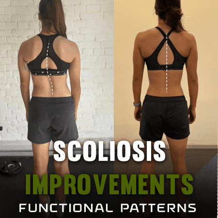 Scoliosis GIF by functionalpatterns