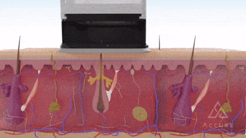 Acne GIF