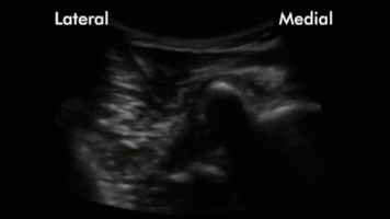 downeastem shoulder dislocation ultrasound GIF