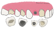 Dental Crown Sticker