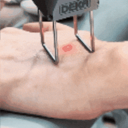 DermaproLaser giphygifmaker skincare manos piel GIF