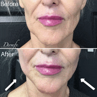 GIF by DermFx
