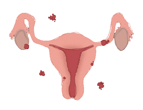acamisart giphyupload uterus endometriosis endometriose Sticker
