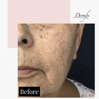 GIF by DermFx