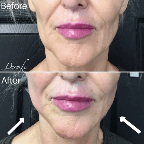 GIF by DermFx