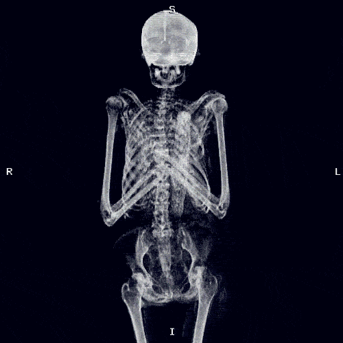 kingkaps7 giphyupload kingkaps7 x-rays of me GIF
