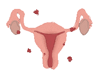 acamisart uterus endometriosis endometriose utero Sticker