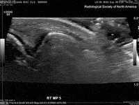 ultrasound cracking GIF by University of California