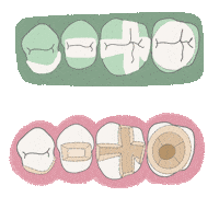 Overlay Inlay Sticker