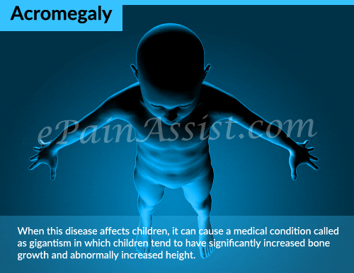 what is acromegaly? GIF by ePainAssist