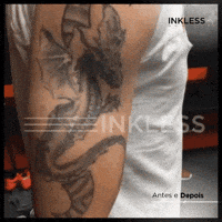 Tattoo Removal GIF by inklessremove