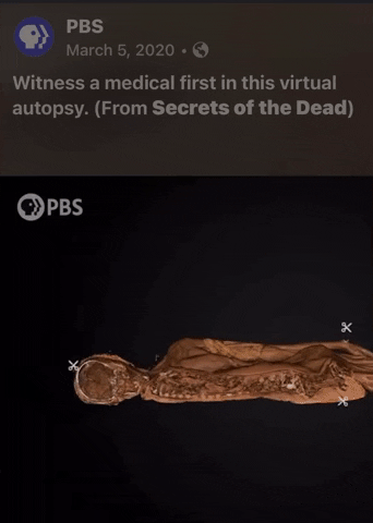 misciel pbs smallpox secrets of the dead GIF