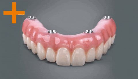 atlantisdentalcare giphygifmaker giphyattribution dental implants affordable dental implants GIF