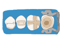 Overlay Inlay Sticker