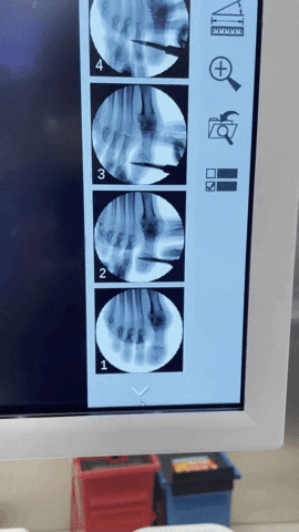 grahamdpm giphyupload mis podiatry hammertoe GIF